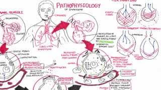 Emphysema  Pathophysiology COPD [upl. by Kreis]