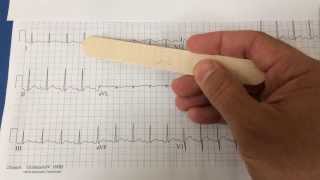 pericarditis on EKG [upl. by Natalia]