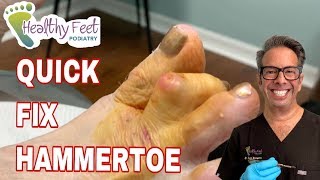 Quick Fix Hammertoe [upl. by Ahsinauq783]