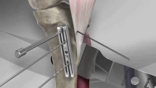 Tibial Tubercle Osteotomy with Arthrex® T3 AMZ System [upl. by Tia559]