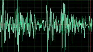 Aortic Regurgitation slow [upl. by Auoh267]