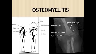 Acute Osteomyelitis [upl. by Able]