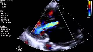 Aortic amp Mitral Regurgitation [upl. by Birmingham]