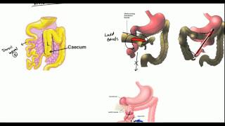 Gut Malrotation Nonrotation and Volvulus for USMLE [upl. by Emia507]