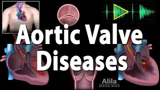 Aortic Valve Disease Animation [upl. by Ragen409]