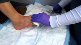 Hammertoe Surgery Pin Removal [upl. by Maier]