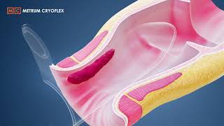 MILH procedure  Minimally Invasive Laser Hemorrhoidoplasty METRUM CRYOFLEX [upl. by Yzdnil]