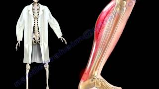 Achilles Tendon Stress amp Strain  Everything You Need To Know  Dr Nabil Ebraheim [upl. by Ilan]