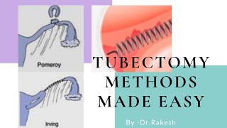 Tubectomy methods [upl. by Adham150]