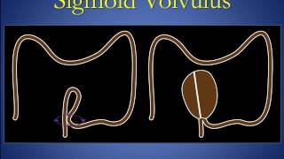 Cecal and sigmoid volvulus version 1 0 edit [upl. by Gujral]