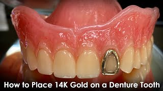 How to Place 14K Gold on a Denture Tooth [upl. by Yerffoj]