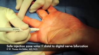 Live Surgery Digital Block Anesthesia of the Finger [upl. by Sumedocin]