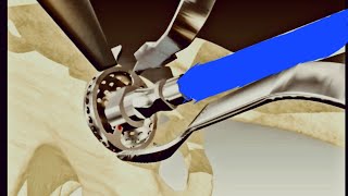 Ilioinguinal Approach to Acetabulum fracture Fixation [upl. by Xaviera]