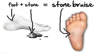 Stone Bruise Foot Pain HOME Treatment [upl. by Deirdra]