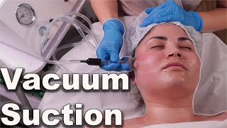 Vacuum suction facial treatment  avoid pore bruising step by step demo 2021 [upl. by Nwonknu691]