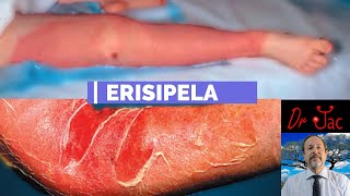 Erisipela [upl. by Milka]