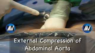 Aortic Compression [upl. by Sivehc602]