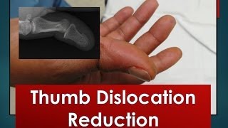 Thumb Dislocation Reduction [upl. by Bartlet725]