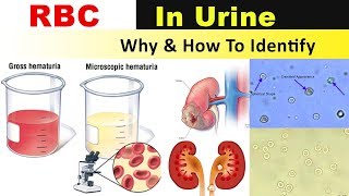 RBC In Urine  Why amp How to Identify [upl. by Eimarej390]