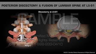 Posterior Discectomy amp Fusion of Lumbar Spine at L5S1 [upl. by Stanleigh]