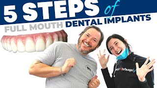 Full Mouth Dental Implant Procedure StepbyStep [upl. by Doelling]