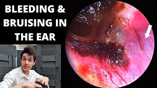 EAR EXAMINATION with complete steps in easy way [upl. by Selassie]