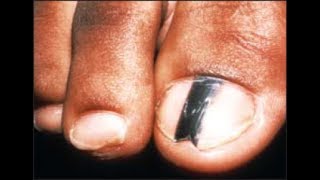 Are Black Toenail Lines amp Streaks Safe Doctor Treatment [upl. by Epoillac]