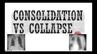 How to differentiate consolidation from collapse in a Chest Xray [upl. by Gabor]