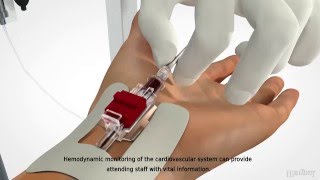 MEDBAR  Arterial Cannula [upl. by Colman]