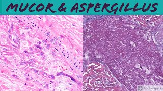 Mucormycosis amp Aspergillosis Angioinvasive Fungal Infection [upl. by Odlabso540]