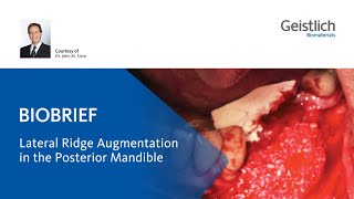 Lateral Ridge Augmentation in the posterior Mandible [upl. by Sakmar352]