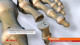 PHALINX™ Hammertoe Fixation System [upl. by Hertha312]