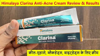 Himalaya Clarina Anti Acne Cream Review  1 Month Results [upl. by Zailer]