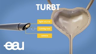 Bladder cancer treatment TURBT [upl. by Alekahs]