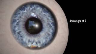 How LASIK Eye Surgery Is Performed [upl. by Ferriter]