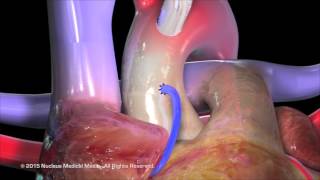 Coronary Artery Bypass Grafting CABG [upl. by Laven]