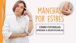 Manchas en la Piel por Estrés  Aprende a Evitarlas [upl. by Attey]