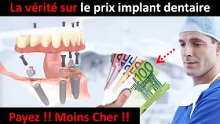 Prix implant dentaire  partie 1 [upl. by Assenna]