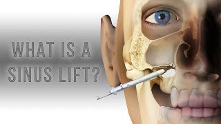 What is a sinus lift [upl. by Dex590]