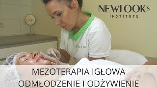 MEZOTERAPIA IGŁOWA  widoczny lifting i intensywne odżywienie [upl. by Yllier822]