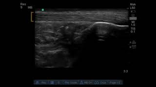 Achilles Tendon Rupture US Annotated JETem 2019 [upl. by Wootten]