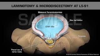 Laminotomy amp Microdiscectomy at L5S1 [upl. by Giacinta384]