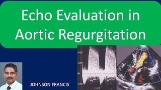 What is aortic regurgitation [upl. by Frank978]