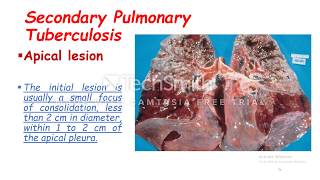 Secondary Pulmonary Tuberculosis [upl. by Annor]