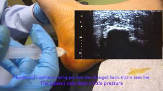 2 Minute Lumbar Transforaminal Epidural Injection [upl. by Ahsitaf]