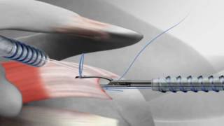 ACL surgery Graft preparation  Four strands Hamstrings Graft [upl. by Brainard50]