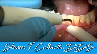 Scaling amp Root Planing  Dental Minute with Steven T Cutbirth DDS [upl. by Eerpud]