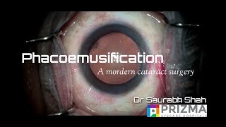 Phacoemulsification Procedure Explained  Ultramodern Cataract Surgery [upl. by Kciwdahc344]