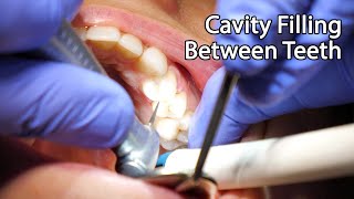 Dentist Filling A Cavity Between Teeth [upl. by Phillip]