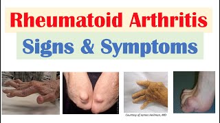 Rheumatoid Arthritis RA Signs amp Symptoms amp Associated Complications [upl. by Aminta964]